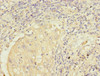 Immunohistochemistry of paraffin-embedded human lung cancer using CSB-PA857449ESR1HU at dilution of 1:100