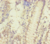 Immunohistochemistry of paraffin-embedded human colon cancer using CSB-PA853497ESR2HU at dilution of 1:100