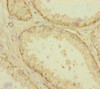 Immunohistochemistry of paraffin-embedded human prostate cancer using CSB-PA878835ESR1HU at dilution of 1:100