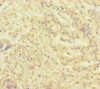 Immunohistochemistry of paraffin-embedded human pancreatic cancer using CSB-PA021074ESR2HU at dilution of 1:100