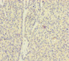 Immunohistochemistry of paraffin-embedded human ovarian cancer using CSB-PA621875ESR1HU at dilution of 1:100