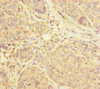 Immunohistochemistry of paraffin-embedded human ovarian cancer using CSB-PA868398ESR2HU at dilution of 1:100