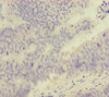 Immunohistochemistry of paraffin-embedded human colon cancer using CSB-PA822192ESR1HU at dilution of 1:100