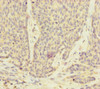 Immunohistochemistry of paraffin-embedded human ovarian cancer using CSB-PA025409ESR1HU at dilution of 1:100