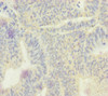 Immunohistochemistry of paraffin-embedded human colon cancer using CSB-PA007382ESR2HU at dilution of 1:100