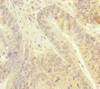 Immunohistochemistry of paraffin-embedded human colon cancer using CSB-PA896481ESR1HU at dilution of 1:100