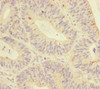 Immunohistochemistry of paraffin-embedded human colon cancer using CSB-PA015156ESR1HU at dilution of 1:100
