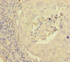 Immunohistochemistry of paraffin-embedded human lung cancer using CSB-PA897573ESR1HU at dilution of 1:100