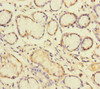 Immunohistochemistry of paraffin-embedded human gastric cancer using CSB-PA890745DSR1HU at dilution of 1:100