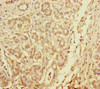 Immunohistochemistry of paraffin-embedded human pancreatic cancer using CSB-PA890745DSR2HU at dilution of 1:100