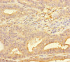 Immunohistochemistry of paraffin-embedded human endometrial cancer using CSB-PA618760DSR1HU at dilution of 1:100
