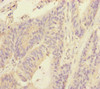 Immunohistochemistry of paraffin-embedded human colon cancer using CSB-PA853432ESR1HU at dilution of 1:100