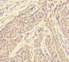 Immunohistochemistry of paraffin-embedded human ovarian cancer using CSB-PA853432ESR1HU at dilution of 1:100