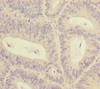 Immunohistochemistry of paraffin-embedded human colon cancer using CSB-PA853432ESR2HU at dilution of 1:100