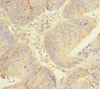 Immunohistochemistry of paraffin-embedded human colon cancer using CSB-PA723351ESR1HU at dilution of 1:100