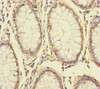 Immunohistochemistry of paraffin-embedded human colon cancer using CSB-PA875728ESR1HU at dilution of 1:100