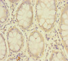 Immunohistochemistry of paraffin-embedded human colon cancer using CSB-PA835673ESR1HU at dilution of 1:100