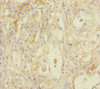 Immunohistochemistry of paraffin-embedded human lung cancer using CSB-PA892131ESR1HU at dilution of 1:100