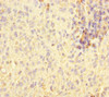 Immunohistochemistry of paraffin-embedded human melanoma using CSB-PA892131ESR1HU at dilution of 1:100