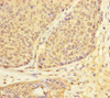 Immunohistochemistry of paraffin-embedded human ovarian cancer using CSB-PA850427ESR2HU at dilution of 1:100