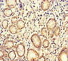Immunohistochemistry of paraffin-embedded human gastric cancer using CSB-PA002882LA01HU at dilution of 1:100