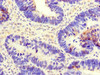 Immunohistochemistry of paraffin-embedded human ovarian cancer using CSB-PA005241LA01HU at dilution of 1:100 Immunohistochemistry of paraffin-embedded human ovarian cancer using CSB-PA005241LA01HU at dilution of 1:100