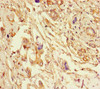 Immunohistochemistry of paraffin-embedded human pancreatic cancer using CSB-PA007791LA01HU at dilution of 1:100 Immunohistochemistry of paraffin-embedded human pancreatic cancer using CSB-PA007791LA01HU at dilution of 1:100
