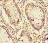 Immunohistochemistry of paraffin-embedded human colon cancer using CSB-PA015545LA01HU at dilution of 1:100