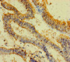 Immunohistochemistry of paraffin-embedded human endometrial cancer using CSB-PA01825A0Rb at dilution of 1:100