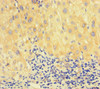 Immunohistochemistry of paraffin-embedded human liver cancer using CSB-PA019268LA01HU at dilution of 1:100
