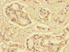 Immunohistochemistry of paraffin-embedded human pancreatic cancer using CSB-PA020645LA01HU at dilution of 1:100