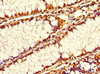 Immunohistochemistry of paraffin-embedded human colon cancer using CSB-PA021335LA01HU at dilution of 1:100