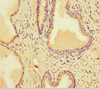 Immunohistochemistry of paraffin-embedded human prostate cancer using CSB-PA021798LA01HU at dilution of 1:100