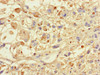 Immunohistochemistry of paraffin-embedded human melanoma using CSB-PA022470LA01HU at dilution of 1:100