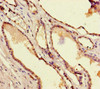 Immunohistochemistry of paraffin-embedded human prostate cancer using CSB-PA023095LA01HU at dilution of 1:100