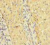 Immunohistochemistry of paraffin-embedded human liver cancer using CSB-PA023302HA01HU at dilution of 1:100
