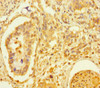 Immunohistochemistry of paraffin-embedded human pancreatic cancer using CSB-PA023302HA01HU at dilution of 1:100