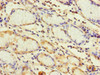 Immunohistochemistry of paraffin-embedded human gastric cancer using CSB-PA023599LA01HU at dilution of 1:100