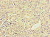 Immunohistochemistry of paraffin-embedded human liver cancer using CSB-PA024147LA01HU at dilution of 1:100