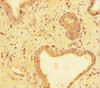 Immunohistochemistry of paraffin-embedded human prostate cancer using CSB-PA025308HA01HU at dilution of 1:100