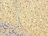 Immunohistochemistry of paraffin-embedded human liver cancer using CSB-PA025944EA01HU at dilution of 1:100