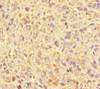 Immunohistochemistry of paraffin-embedded human melanoma using CSB-PA05009A0Rb at dilution of 1:100