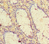 Immunohistochemistry of paraffin-embedded human colon cancer using CSB-PA10509A0Rb at dilution of 1:100