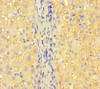 Immunohistochemistry of paraffin-embedded human liver cancer using CSB-PA388827LA01HU at dilution of 1:100