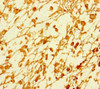 Immunohistochemistry of paraffin-embedded human melanoma using CSB-PA624030HA01HU at dilution of 1:100