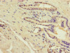 Immunohistochemistry of paraffin-embedded human prostate cancer using CSB-PA674579LA01HU at dilution of 1:100