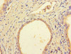 Immunohistochemistry of paraffin-embedded human prostate cancer using CSB-PA725896HA01HU at dilution of 1:100