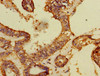 Immunohistochemistry of paraffin-embedded human endometrial cancer using CSB-PA725896HA01HU at dilution of 1:100