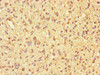 Immunohistochemistry of paraffin-embedded human glioma using CSB-PA727750LA01HU at dilution of 1:100