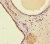 Immunohistochemistry of paraffin-embedded human prostate cancer using CSB-PA747798LA01HU at dilution of 1:100